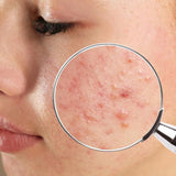 Acne Treatment Plan 1  (6 months)