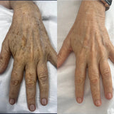 Laser Rejuvenation