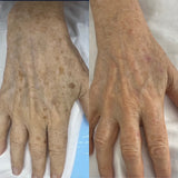 Laser Pigmentation
