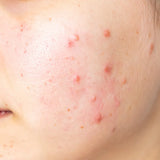 Acne Treatment Plan 2  (6 months)