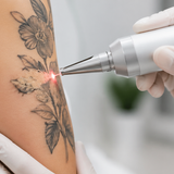 Tattoo Removal Theory