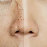 Laser Pigmentation