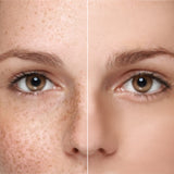 Pigmentation/Melasma Treatment Plan (6 months)