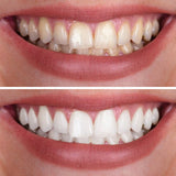 Crystal White Teeth Whitening